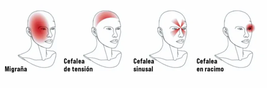 Headache Types Killing Your Neck C Sm Es